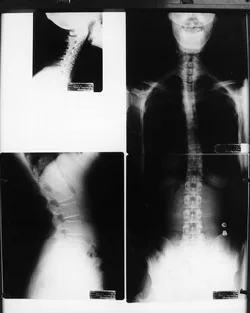 Set of spinal x-rays